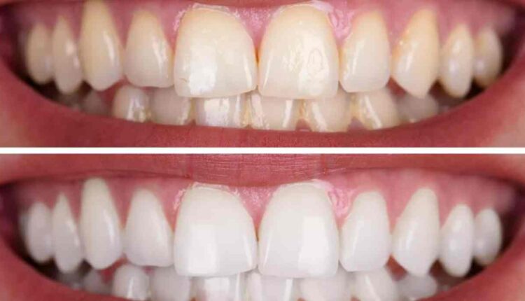 Conseils pour blanchir les dents